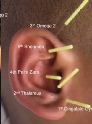 Auriculotherapy ear acupuncture treatment